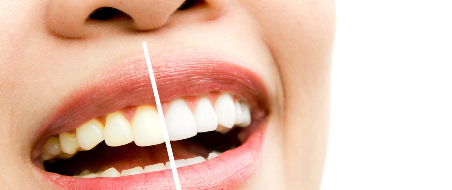 woman teeth before and after whitening. Over white background