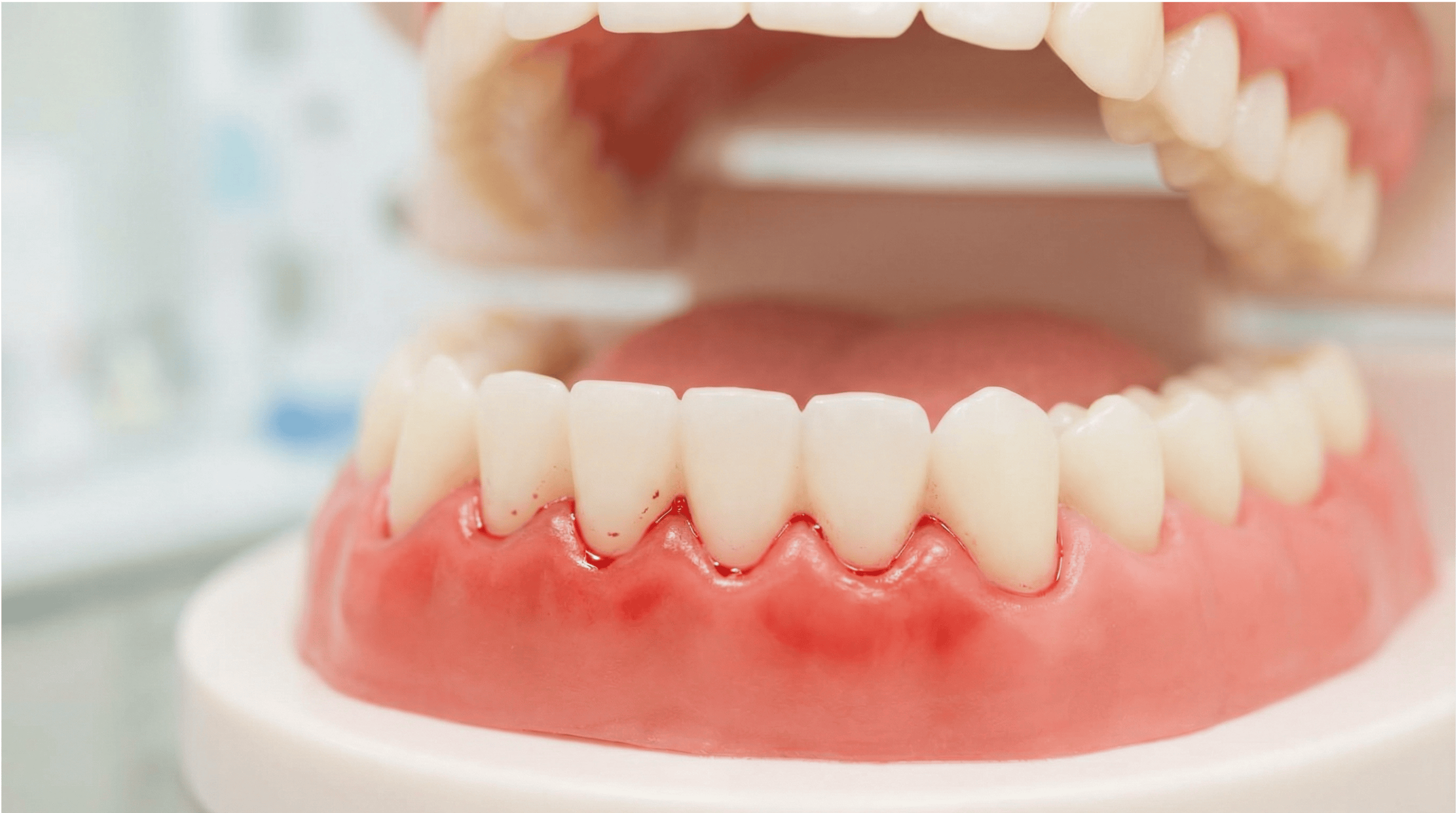 Je krvácanie ďasien „normálne“, ak nebolí?