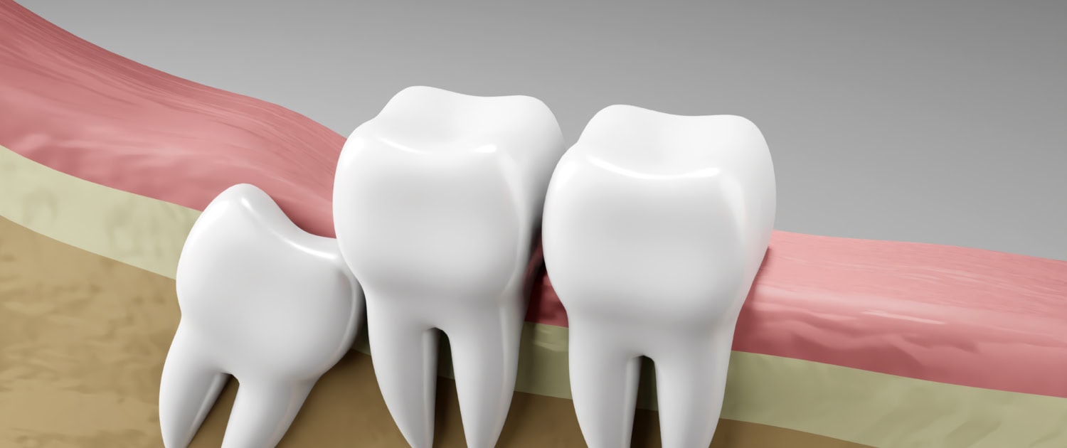 Wisdom tooth impaction. Oral health and dental inspection teeth.