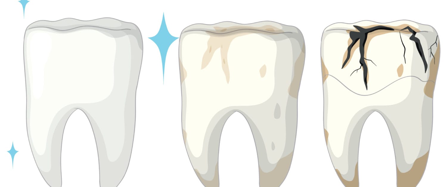 Stages of Tooth Decay Illustration